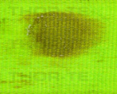 Sling Acid or Alkali Burns Sling Acid or Alkali Burns